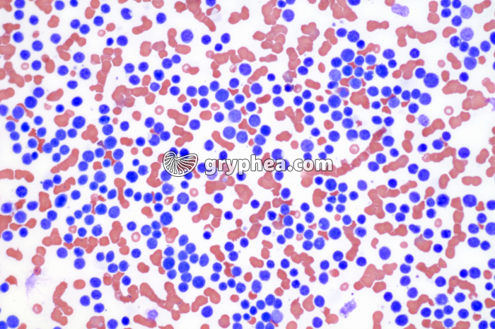 Leucémie aigüe x100 - gryphea.org